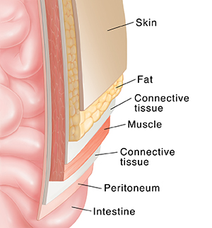 Cross section of abdominal wall over intestine showing layers: skin, fat, connective tissue, muscle, connective tissue, and peritoneum.