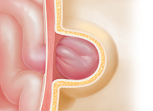 Corte transversal de una pared corporal donde puede verse una hernia. El intestino sobresale por el defecto en el músculo debajo de la piel y queda atrapado allí.