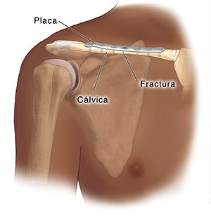 Vista anterior de la articulación del hombro que muestra huesos con dispositivo de fijación interna enroscados en la clavícula fracturada.